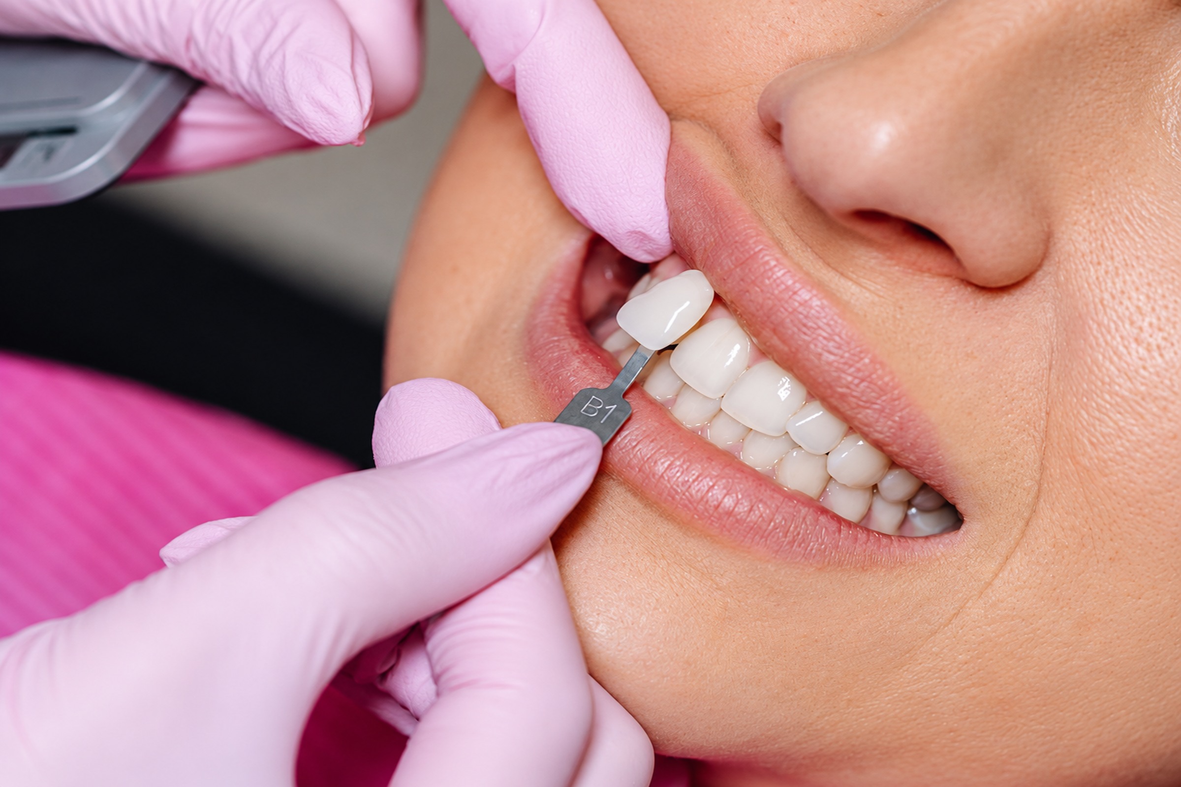In-Office Bleaching mit professioneller Zahnfarbbestimmung
