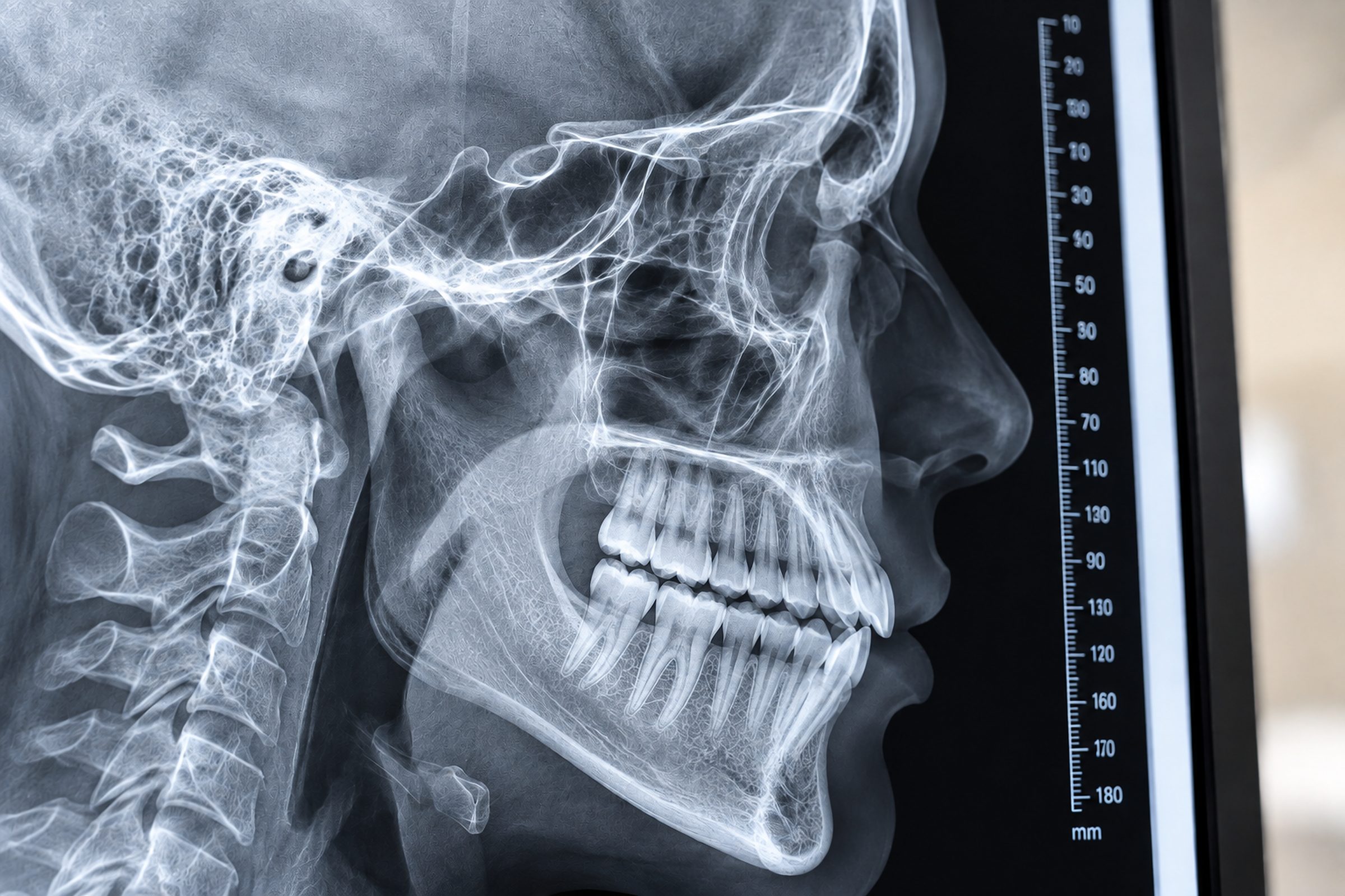Digitales Fernröntgenseitenbild zur zahnmedizinischen Diagnostik