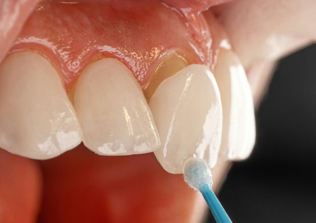 Veneers aus Keramik zur ästhetischen Gestaltung der Frontzähne