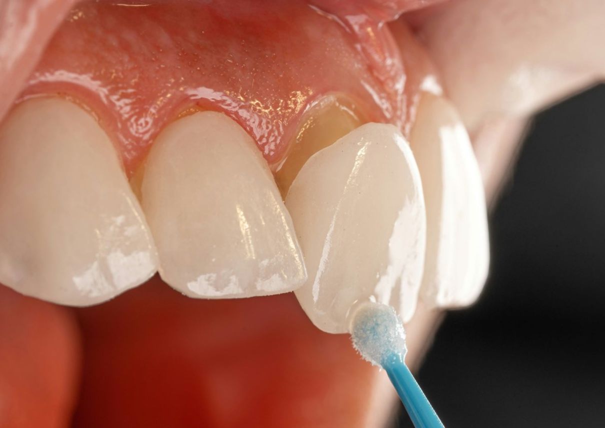 Veneers für eine ästhetische Verbesserung von Form und Farbe der Zähne